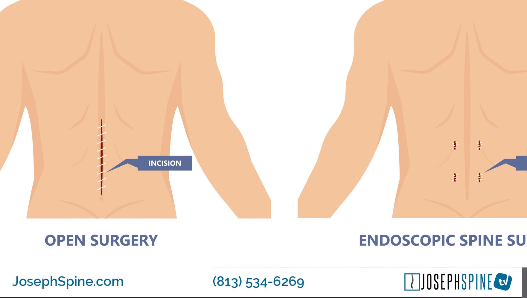 disc-herniation-slipped-disc illustration 2