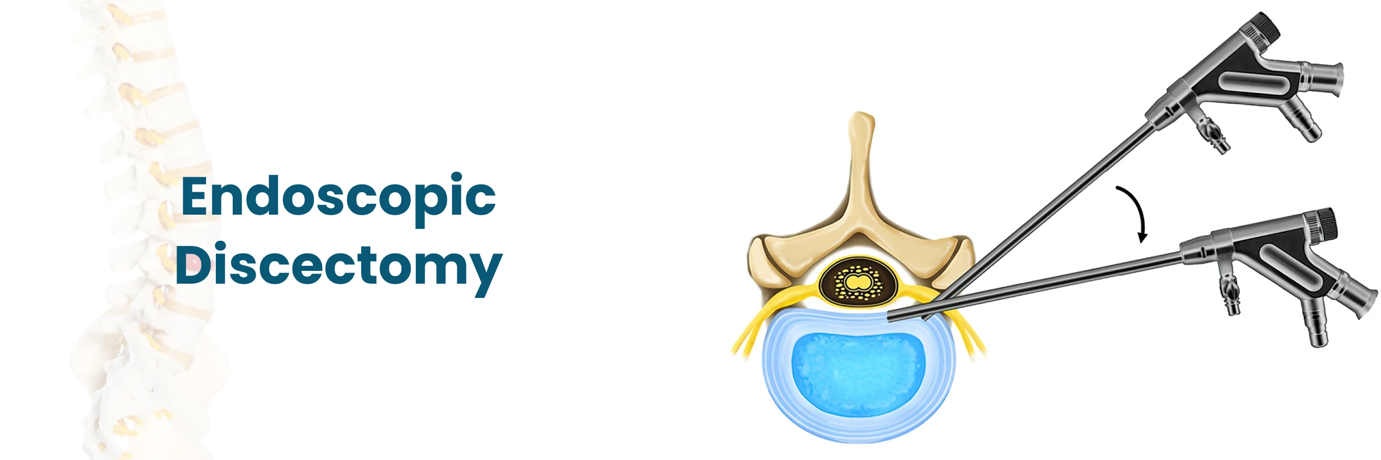 disc-herniation-slipped-disc illustration 3