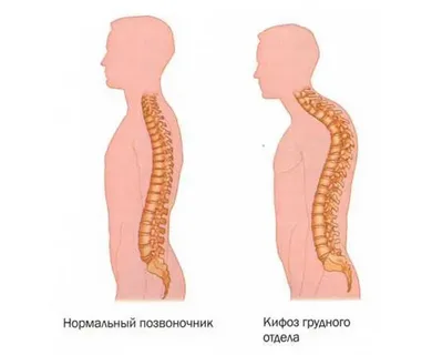kyphosis illustration 2