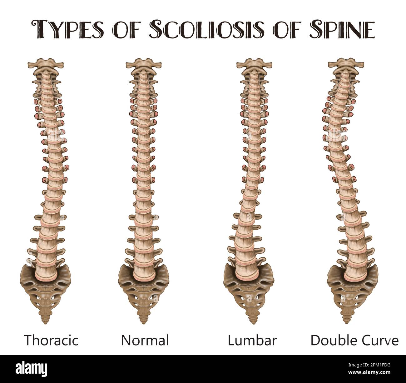 scoliosis illustration 2