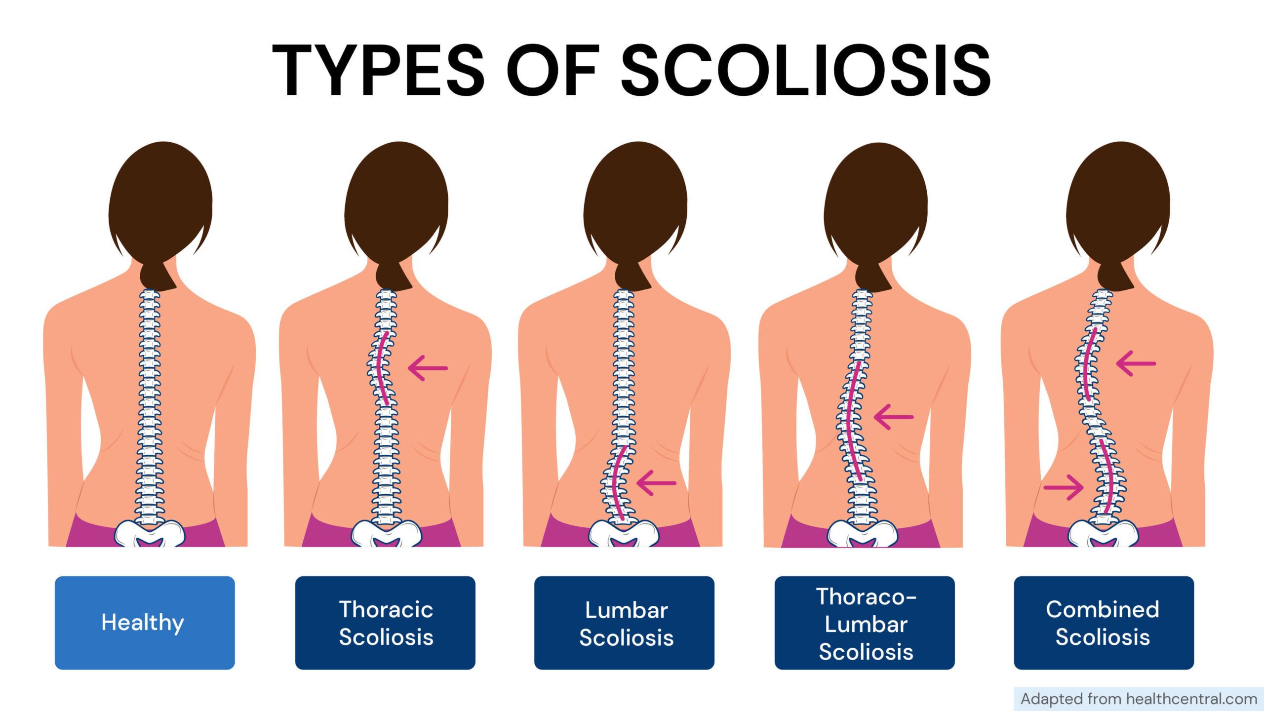 scoliosis illustration 3