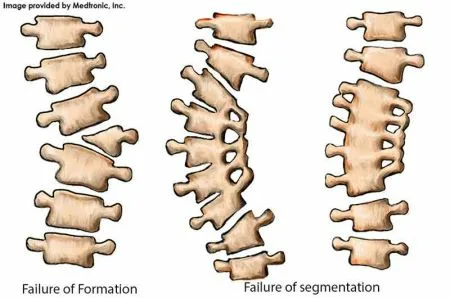 scoliosis illustration 4