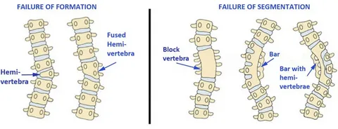 scoliosis illustration 5