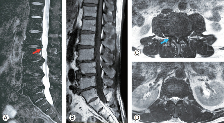 spinal-stenosis illustration 2
