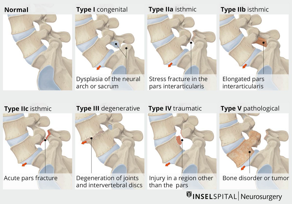 spondylolisthesis illustration 2
